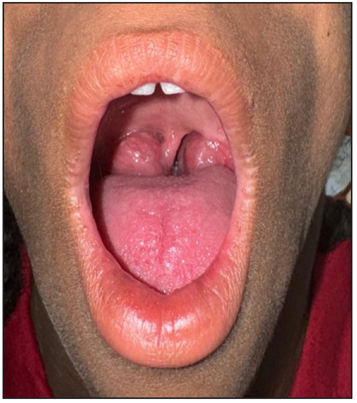 Tonsillar hypertrophy with a right-sided deviation of uvula.