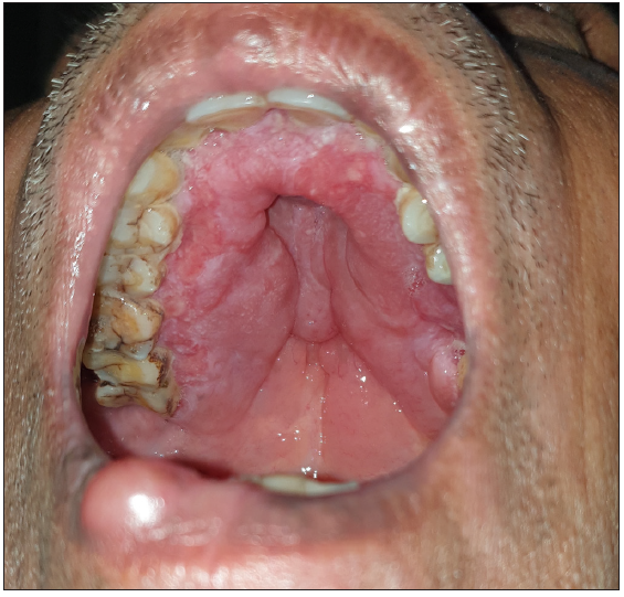 Hypertrophy of the soft and hard palates and nodule on the lower lip.