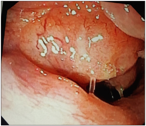 Zero-degree endoscopy (straight angled scope for nose and nasopharynx) showing a mass occupying almost the whole of the nasopharynx.