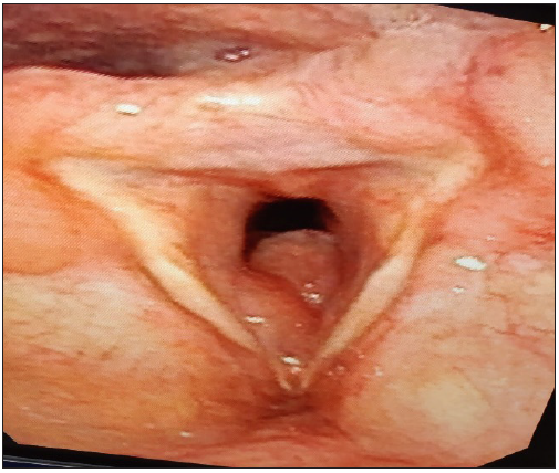 Fibreoptic laryngoscopy showing lesion extending from the anterior commissure to subglottis, obscuring more than 50% of the subglottis.