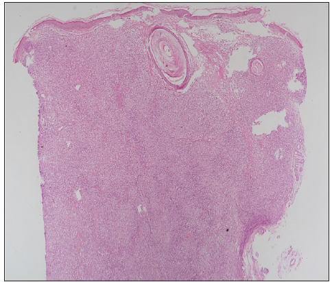Biopsy from nodule on the forehead and hard palate, respectively, showing dense pan-dermal infiltrate composed of foamy histiocytes, histiocytes, lymphocytes and plasma cells (Haematoxylin & Eosin, 100x).