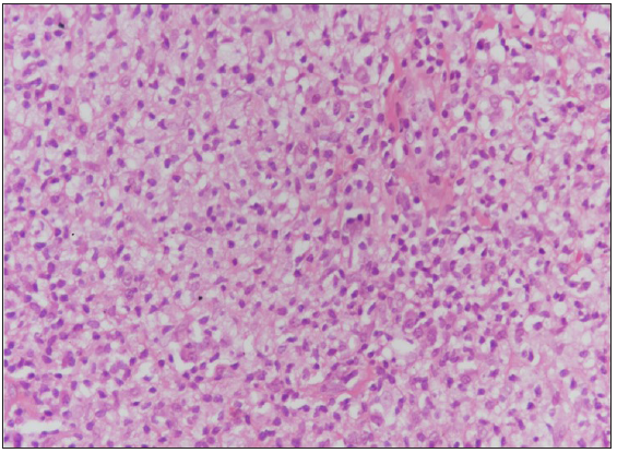 Biopsy from the nodule on the forehead and hard palate, respectively, showing dense pan-dermal infiltrate composed of foamy histiocytes, histiocytes, lymphocytes and plasma cells (Haematoxylin & Eosin, 400x).