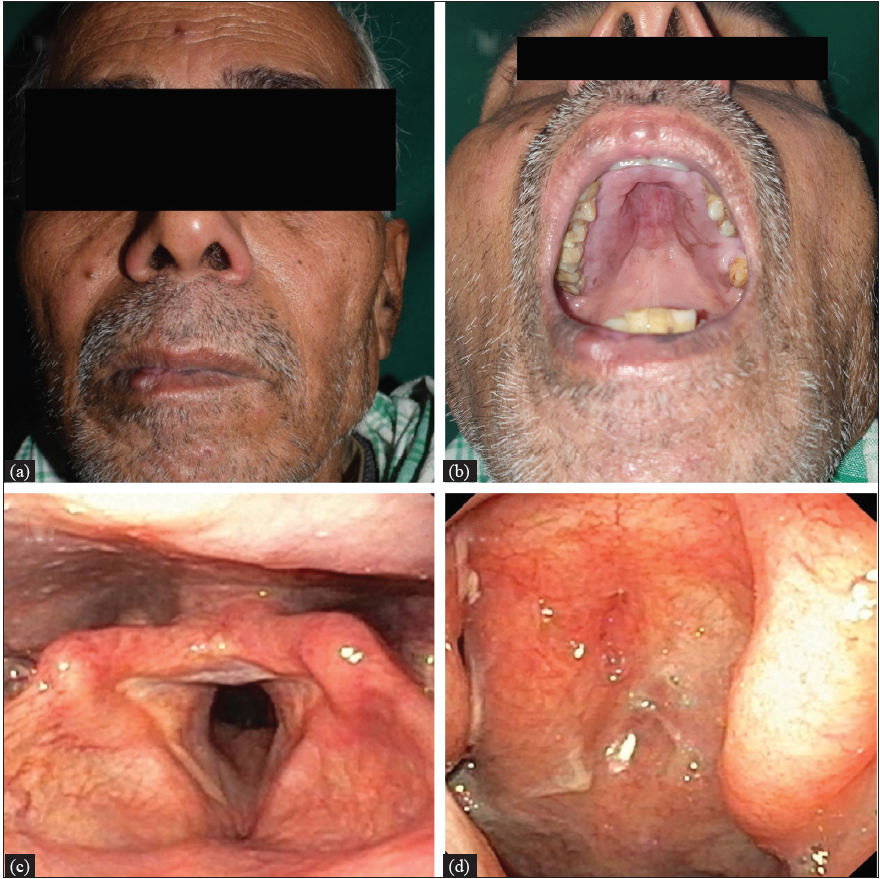 Follow-up at 45 days showing (a) decrease in the size of nodule over lower lip and forehead, (b) decrease in hypertrophy of soft and hard palates and (c) complete resolution of pharyngeal (d) as well as laryngeal lesions.
