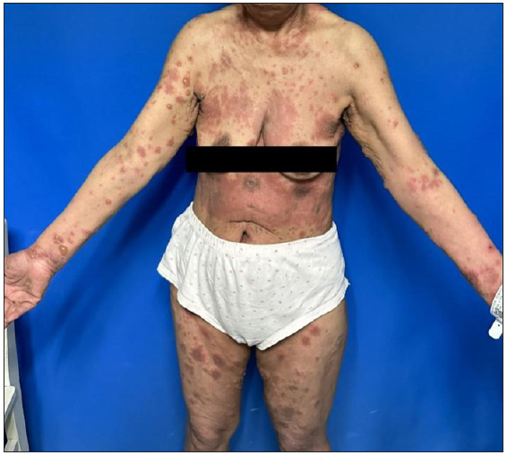 A 70-year-old female with erythema and blisters scattered on her trunk and limbs.