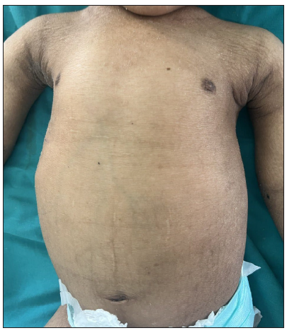 Pectus carinatum with scaling without erythema over body and extremities.