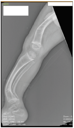 Preoperative X-ray image of the right leg in lateral view showing anterior bowing of femur and distal one-third of the leg, metaphyseal cupping, medullary widening and thinning of cortices.