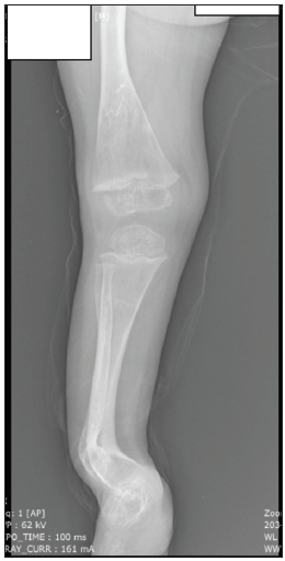 Preoperative X-ray image of left leg in anteroposterior view showing anterolateral bowing of distal femur, distal one-third of the leg, metaphyseal cupping, medullary widening and thinning of cortices.