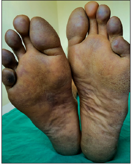 Blue-purple discolouration of toes along with extension of mottling to forefoot.