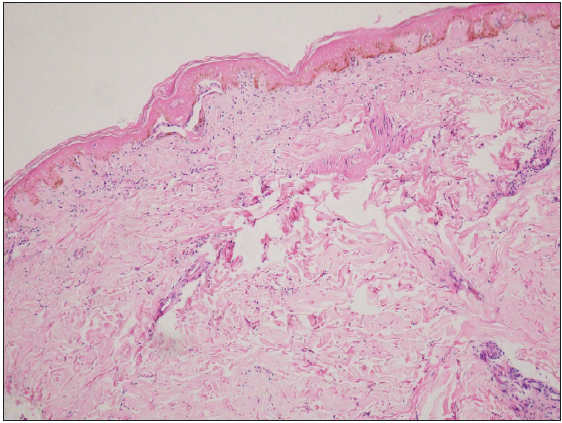 Histopathological examination of skin biopsy specimen revealed epidermal necrosis and ischaemic changes in upper dermis. (Haematoxylin and eosin staining, 100×)