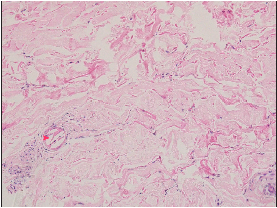 Nuclear debris, fibrin thrombi, along with cholesterol clefts (red arrow) seen within the lumen of dermal vessels. Mixed inflammatory infiltrate comprising of scattered eosinophils and neutrophils are also seen along with collagen degeneration. (Haematoxylin and eosin staining, 400×)