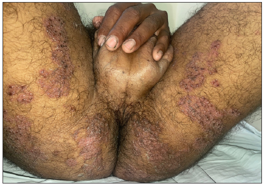 Clustering of these vesicles noted within the annular erythematous lesions over the inner thigh with scaly margins.