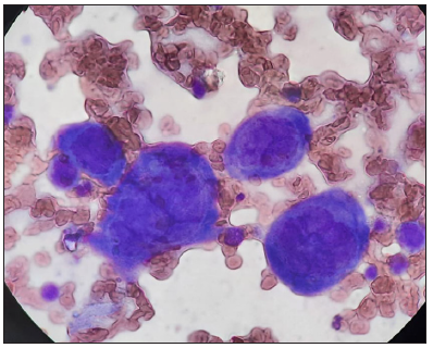 Tzanck smear revealed several multinucleated giant cells and acantholytic cells (Oil immersion, 100x).