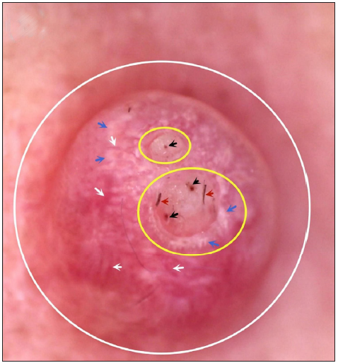 Dermoscopy: A uniform, unstructured pink and pinkish-white hemispherical papule (white circle) with two central yellowish-white depressions (yellow circle), protruding black hair (red arrow), brownish spots (black arrow), and radiating peripheral bright white streaks (blue arrow) accompanied by linear blood vessels (white arrow).