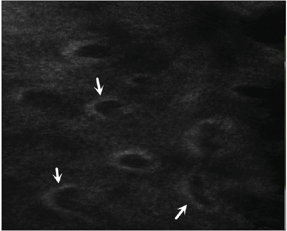 A decreased number of dermal papillary rings, with some appearing as semi-circular and having increased spacing (white arrows).