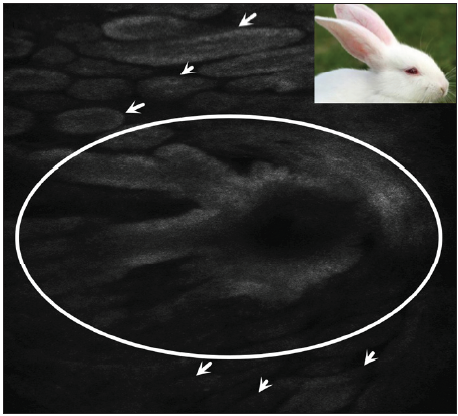 Expanded hair follicles in the superficial and middle dermis exhibiting medium-to-low refraction, and plump finger-like protrusions extending along the hair follicles with medium-to-high refraction (white circles). Variably sized flattened oval and elongated clumps radiating around the expanded hair follicles, presenting a ‘cloud-like radial flow’ appearance (white arrows), rabbit like pattern (inset).