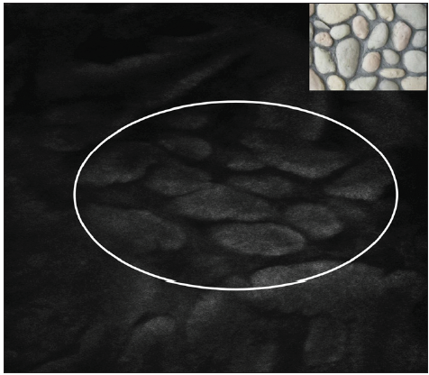 Clumps in certain areas that are relatively uniform in size (white circle), resembling a cobblestone-like appearance (inset).