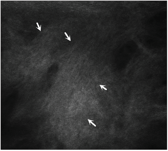 Bundled, thickened collagen fibres adjacent to hair follicles and within the dermis (white arrows).