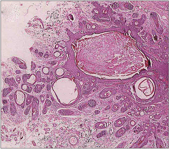 Pronounced expansion of hair follicles in the dermis, containing keratinous material within the follicles and epithelium extending peripherally in cord-like formations, generating numerous secondary follicular cavities in a radiating distribution and secondary or tertiary follicles (Haematoxylin and Eosin, 100x).