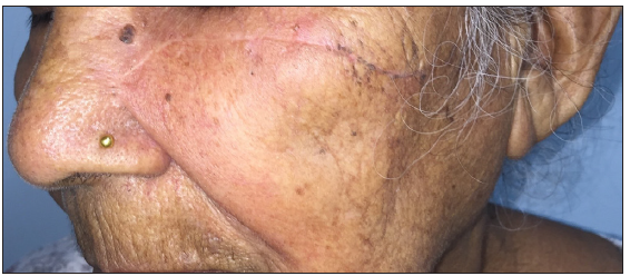 Follow-up images obtained after 8 weeks, demonstrating a well-healed, thin, linear scar.