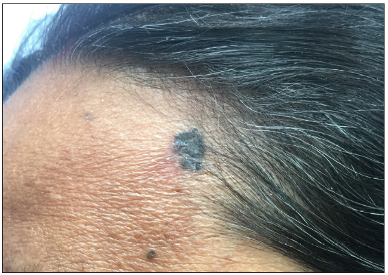 A case of basal cell carcinoma over the scalp margin.