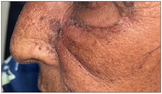 Post-operative clinical photographs after standard surgical excision and advancement flap.