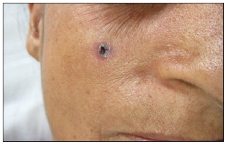 A clinical case illustrating the management of basal cell carcinoma on the cheek using surgical excision followed by advancement flap.