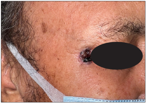 A case of micro-nodular basal cell carcinoma over the lateral margin of the eye showing an ulcerative surface and beaded margin.