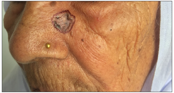 Clinical presentation of basal cell carcinoma on the medial cheek of an elderly woman.