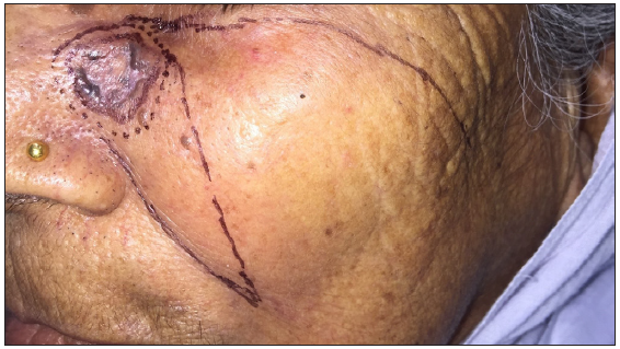 Pre-operative surgical markings delineating excision margins and flap reconstruction plans.