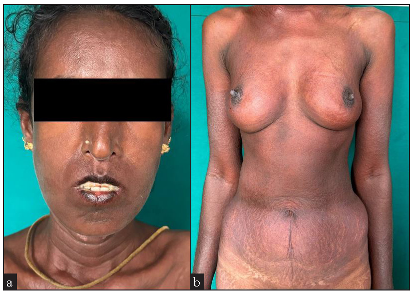 Woman with systemic sclerosis with diffuse maculopapular rash following intake of herbal medicine (Smilax china) (a) over the face with chapped lips and (b) over the trunk.