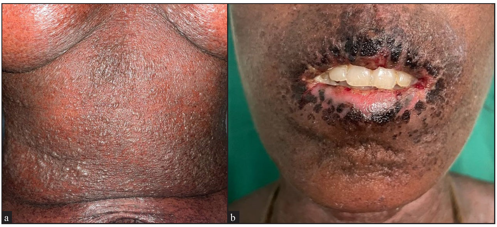 (a) Confluent vesicles and bullae over the trunk with sheets of necrosis on a background of erythema and (b) oral erosions with haemorrhagic and dried up crust over the lips and perioral area suggestive of toxic epidermal necrolysis.