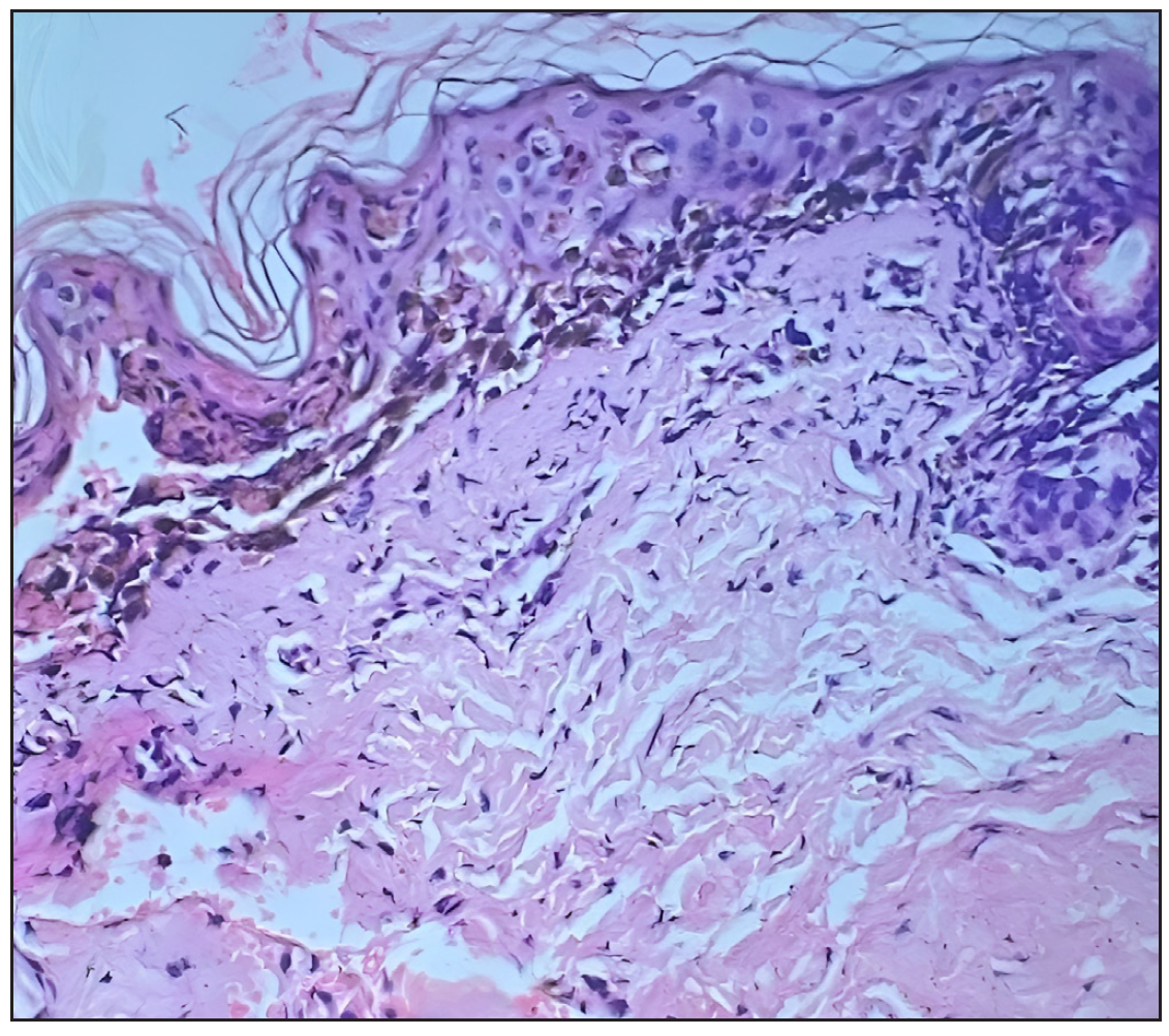 Subepidermal blister with basket weave orthokeratosis, apoptotic keratinocytes with dense lymphocytic infiltrate in the superficial dermis, dermal oedema, and dense collagenised stroma (Haematoxylin and eosin, 400x)