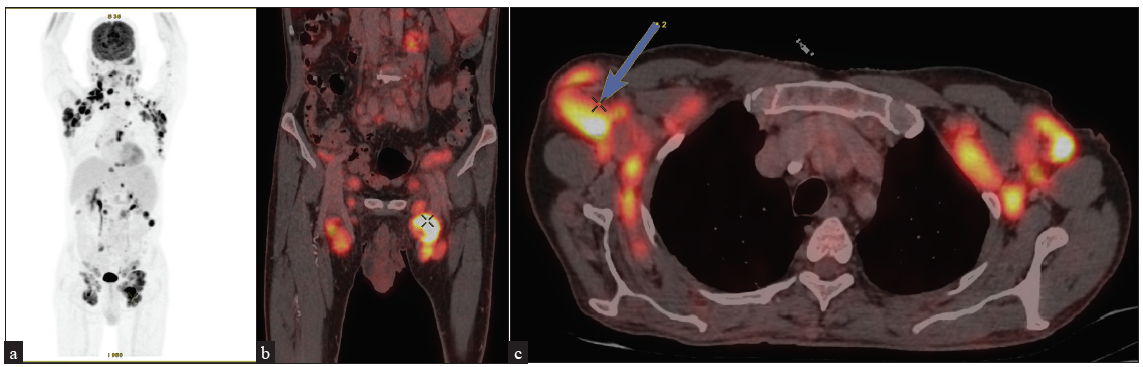 (a) Maximum Intensity Projection of 18F-FDG PET in a patient of mycosis fungoides shows increased uptake in bilateral cervical, axillary, mediastinal, para-aortic, retro-peritoneal, iliac and inguinal lymph nodes. (b, c) Axial and coronal CT, PET and fusion PET/CT images shows increased 18F-FDG uptake in bilateral inguinal, iliac and axillary lymph nodes. (PET: Positron emission tomography, FDG: Fluorodeoxyglucose.)