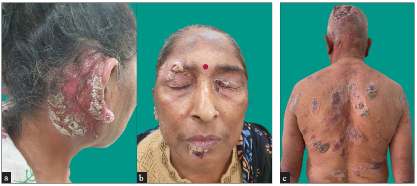 (a and b) Folliculotropic MF involving retroauricular area, scalp, face and trunk. (c) Large cell transformation presenting as ulcer on scalp.