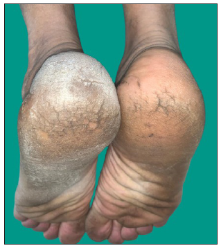 Woringer Kolopp variant of pagetoid reticulosis presenting as a solitary plaque on the left foot.