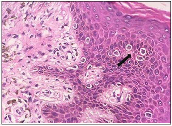 Black arrow shows discrete lining of atypical lymphocytes at the dermo-epidermal junction. (Toy soldier appearance in the patch stage of MF). (Haematoxylin & eosin, 40x).