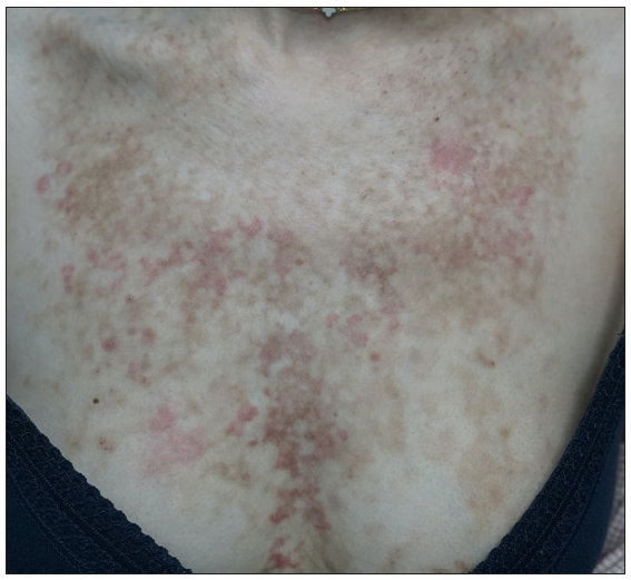 Erythematous papules and plaques with reticular hyperpigmentation on the upper chest (patient 7).