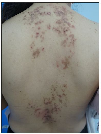 Erythematous macules and reticular hyperpigmentation on the back (patient 8).