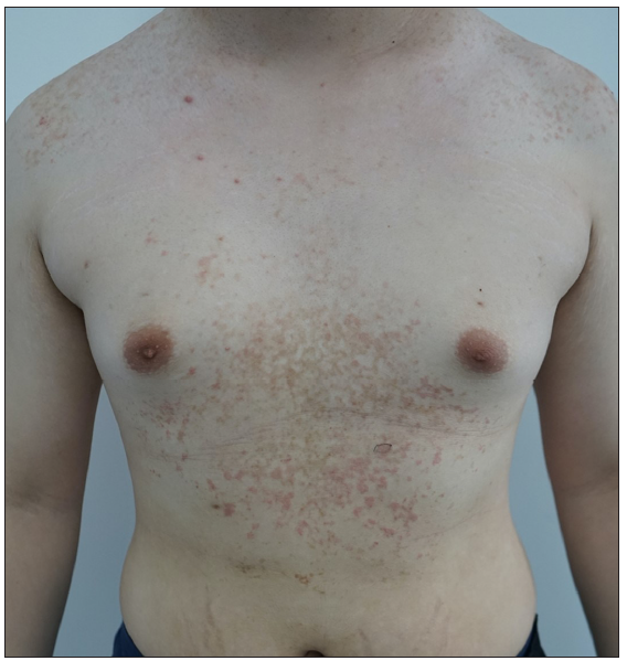 Erythematous macules and reticular hyperpigmentation on the chest (patient 9).