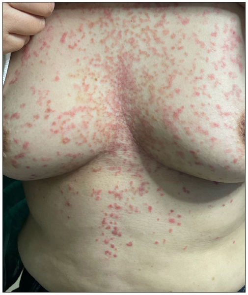 Erythematous papules with reticular hyperpigmentation on the chest and abdomen (patient 10).