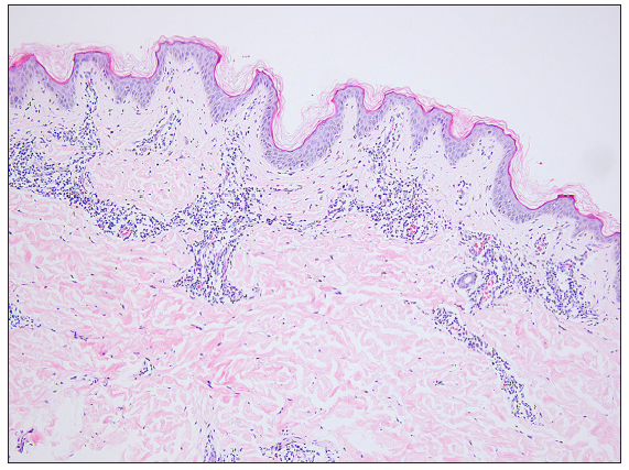 Patient 9: Epidermal hyperkeratosis, prominent acanthosis, perivascular infiltration of lymphocytes and individual eosinophils in the superficial dermis (Haematoxylin & Eosin stain, 100x).