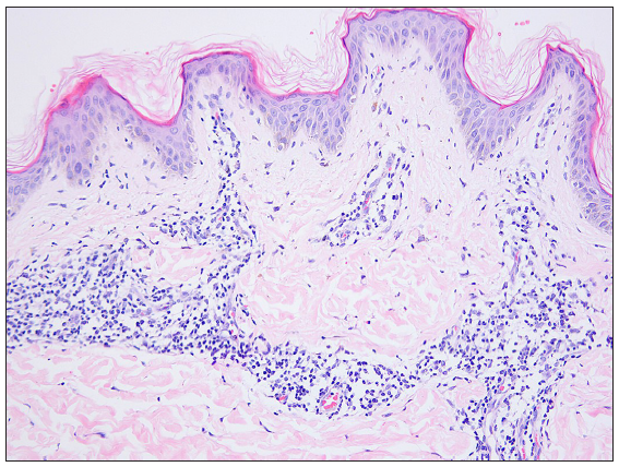 Patient 9: Epidermal hyperkeratosis, prominent acanthosis, perivascular infiltration of lymphocytes and individual eosinophils in the superficial dermis (Haematoxylin & Eosin stain, 200x).