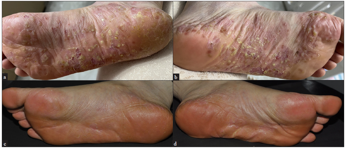 A 38-year-old women in 8 months postpartum with PPP, before Upadacitinib treatment (a-b) and after 12 weeks of updacitinib treatment (c-d).