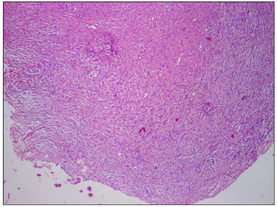 Histopathology of neurofibroma showing spindled tumour cells arranged in a storiform pattern. [Haematoxylin and eosin, 50x].