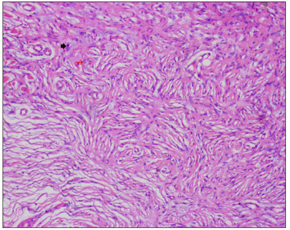 Histopathology of neurofibroma reveals spindled cells with pale bubblegum cytoplasm and wavy nuclei in a storiform pattern (red arrow) and mast cells (black arrow) [Haematoxylin and eosin, 100x].