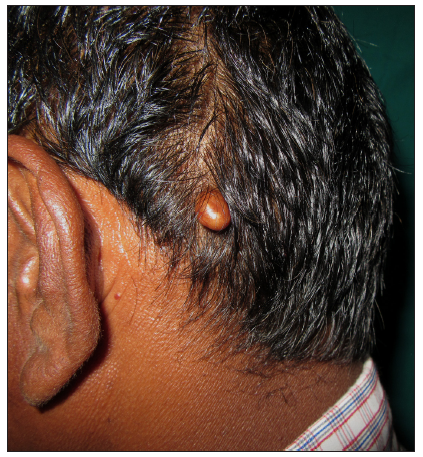 Storiform collagenoma: Solitary brown pedunculated hard nodule on the scalp.