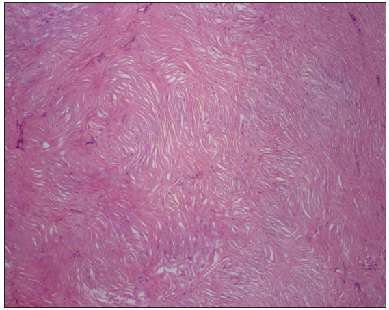 Histopathology of storiform collagenoma depicts the hypocellular area of abundant collagen in a storiform pattern [Haematoxylin and eosin, 100x].