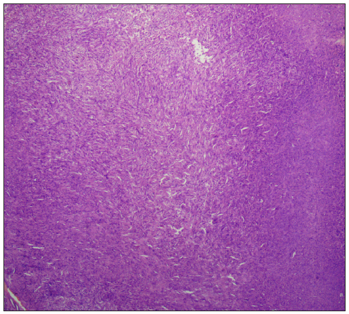 Histopathology of dermatofibroma shows spindle cells in a storiform pattern [Haematoxylin and eosin, 50x].