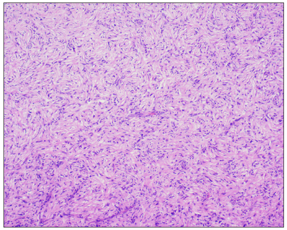 Histopathology of dermatofibroma shows fibroblasts and epithelioid-shaped histiocytes [Haematoxylin and eosin, 100x].