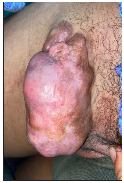 Dermatofibrosarcoma protuberance presenting as a protuberant hypopigmented to skin-coloured nodule over the lower abdomen.